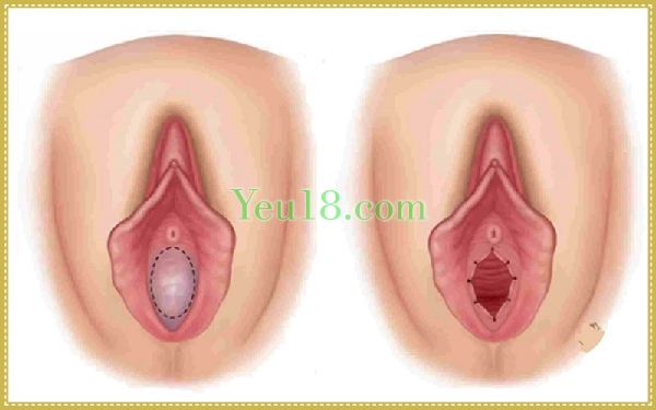 Màng trinh trước và sau khi bị rách