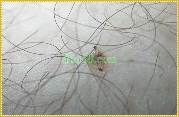 Rận mu là một số nguyên nhân gây nên bạc lông mu